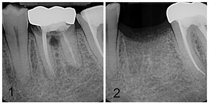 Root canal decay and extracted tooth before