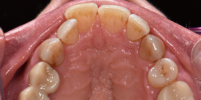 Crooked top row of teeth before treatment