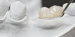 an example of a dental crown on a wax model