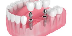 two dental implants with a dental bridge   