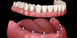six dental implants with a full denture    