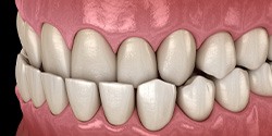 Illustration of an underbite