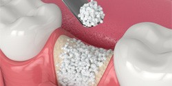 Using bone graft to rebuild jaw for dental implants in Edmond