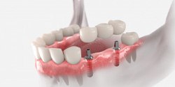 digital illustration of an implant dental bridge