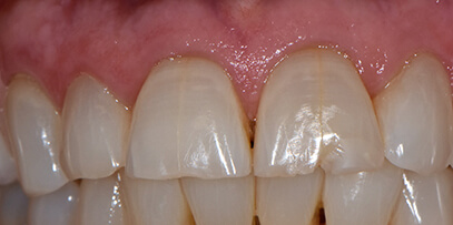 cracked teeth before