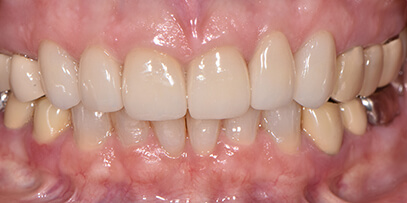 porcelain crowns after