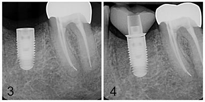 implant correcting decayed tooth after