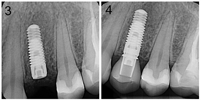 after root canal and dental implant replacement tooth