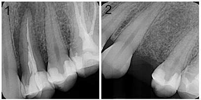 before root canal damage and tooth extracted