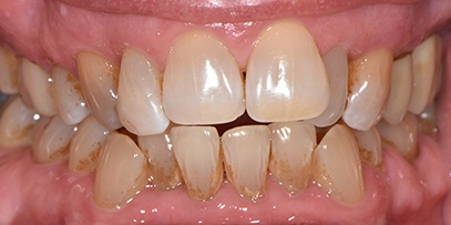 crooked bottom teeth before