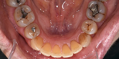 Aligned bottom teeth after Invisalign