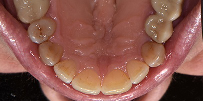 Aligned top teeth after Invisalign