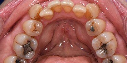 Crooked bottom row of teeth before treatment