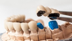 model smile with same day dental crown supported fixed bridge restoration