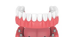 Model of implant-supported denture