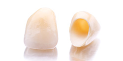 Tooth-colored dental crown prior to placement