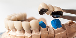 Model of smile with fixed bridge restoration