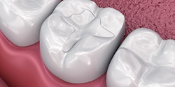 A 3D illustration of tooth-colored fillings