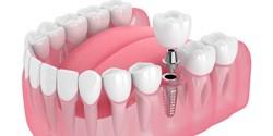 single dental implant with a crown  