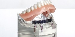 Model dental implant-retained denture