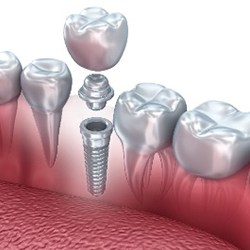 dental implant