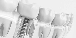 dental implant in the lower jaw