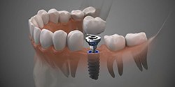 dental implant in the jawbone