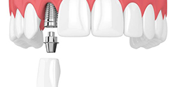 dental implant in the upper jaw