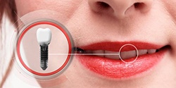 closeup of a woman smiling with animated dental implant beside her cheek