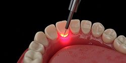 Illustration of dental laser being used to treat gums
