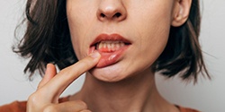 A woman revealing her red and inflamed gum