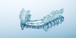 Clear nightguard for bruxism