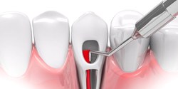 Animated smile during root canal therapy