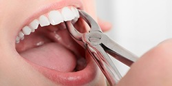 Closeup of a tooth being pulled