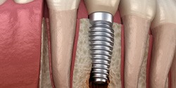 Failed dental implant in Edmond