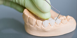 Model smile with dental crown supported fixed bridge restoration