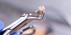 dentist holding an extracted tooth with a dental instrument