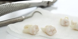 several extracted teeth lying on gauze pad