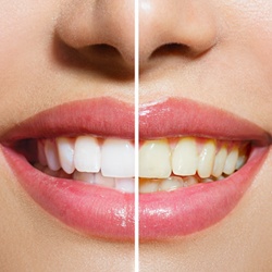 A smile before and after teeth whitening