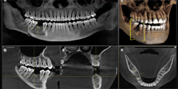 Sample of Xray