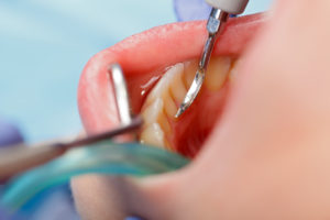 Your dentist in Northwest Oklahoma City does scaling and root planing