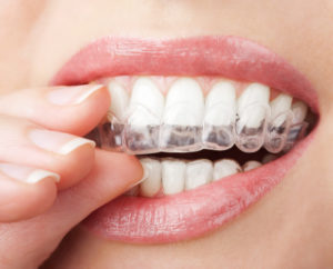 closeup of patient placing invisalign tray