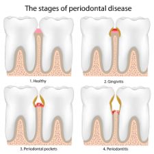 Illustration of the stages of gum disease