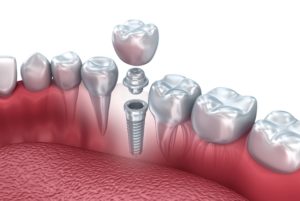 model of each part of dental implants