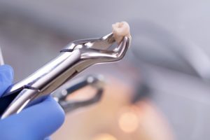 dentist in OKC holding an extracted tooth with a dental instrument 