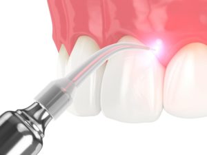 model of a soft tissue dental laser treating the gums 