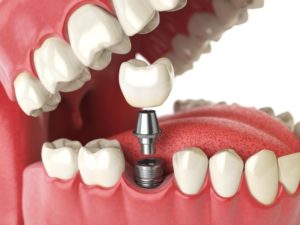 dental implants 3D illustration 