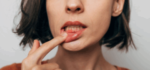 Woman pulling back her lip to reveal inflamed gums